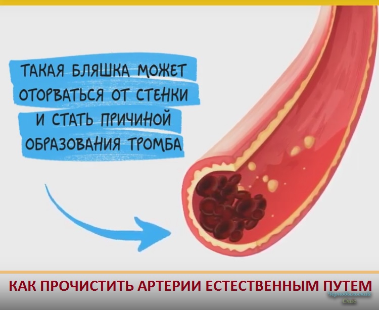 Как прочистить артерии естественным путем