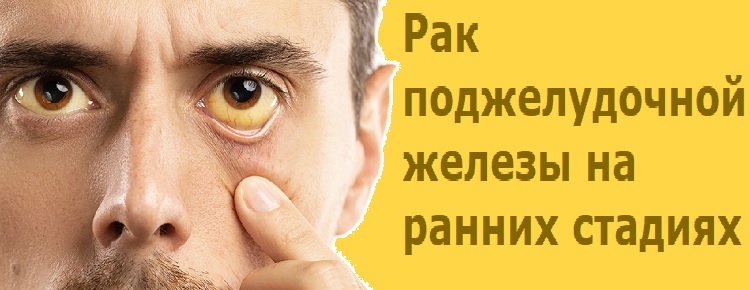 Рак поджелудочной железы на ранних стадиях Рак поджелудочной железы на ранних стадиях